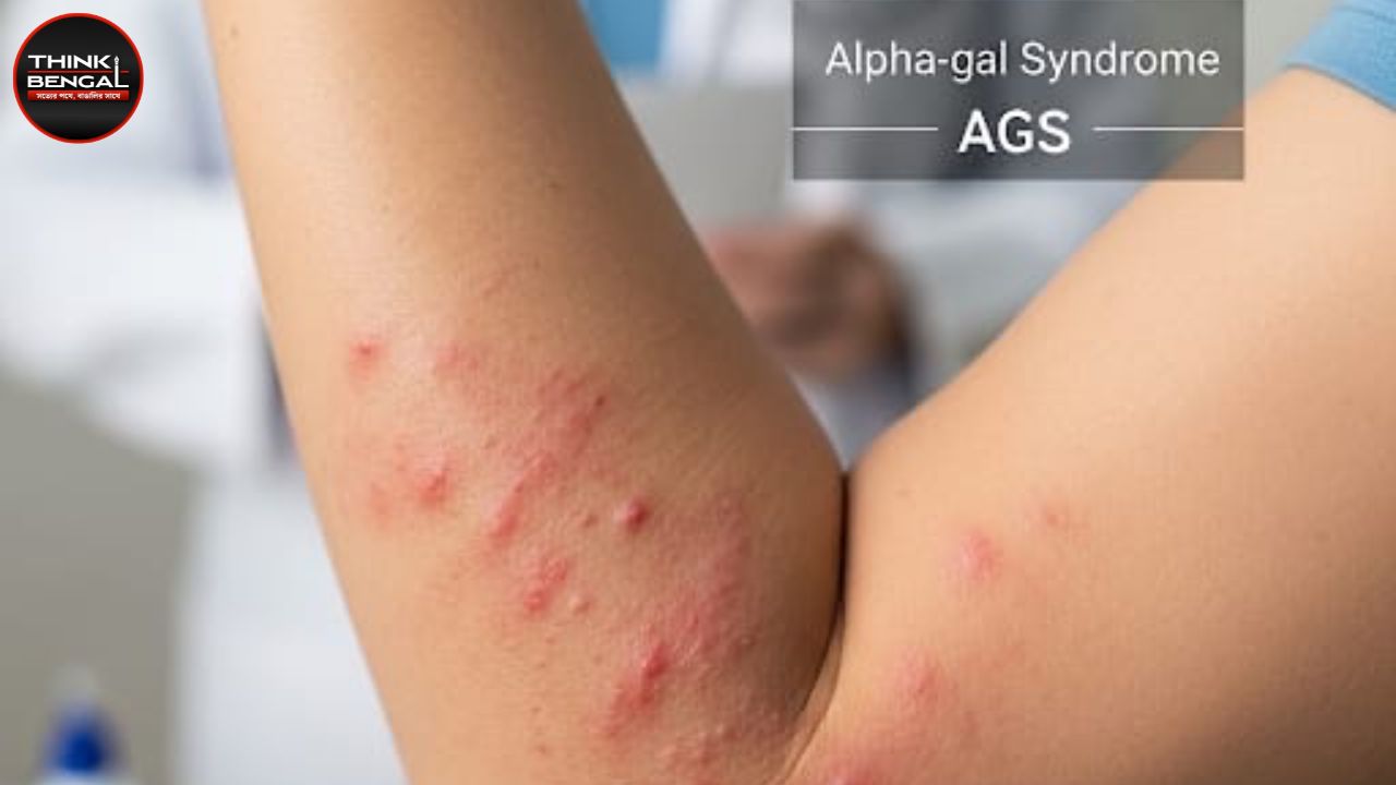 Tick Bite Nightmare What is Alpha-Gal Syndrome and How to Protect Yourself